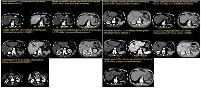 Neoadjuvant Therapy With Cabozantinib as a Bridge to Liver Transplantation in Patients With Hepatocellular Carcinoma (HCC): A Case Report